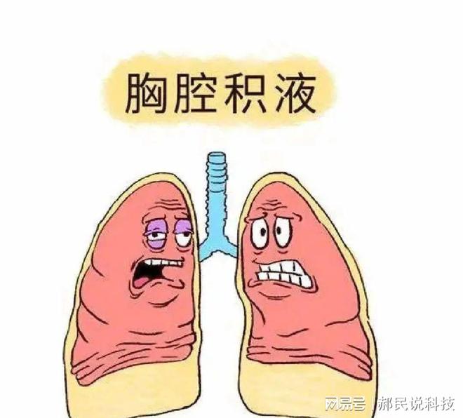 右心衰胸腔积液哪侧为主_右心衰胸腔积液为什么右侧多见_右心衰 胸腔积液